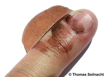 Silbernitrat-Lösung auf Finger